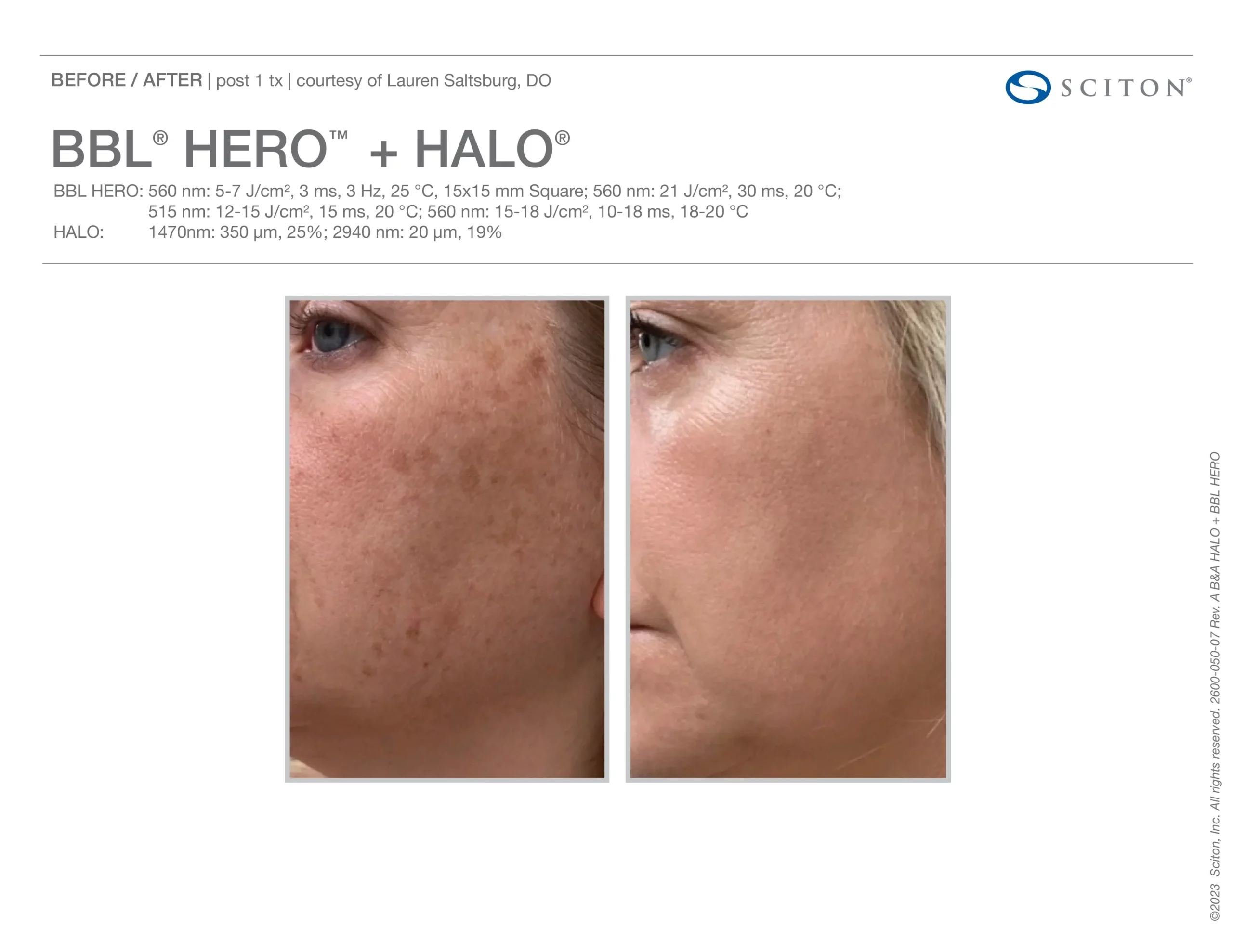 Before and After Sciton Halo Resurfacing by Salt Aesthetics bar in Wilmington