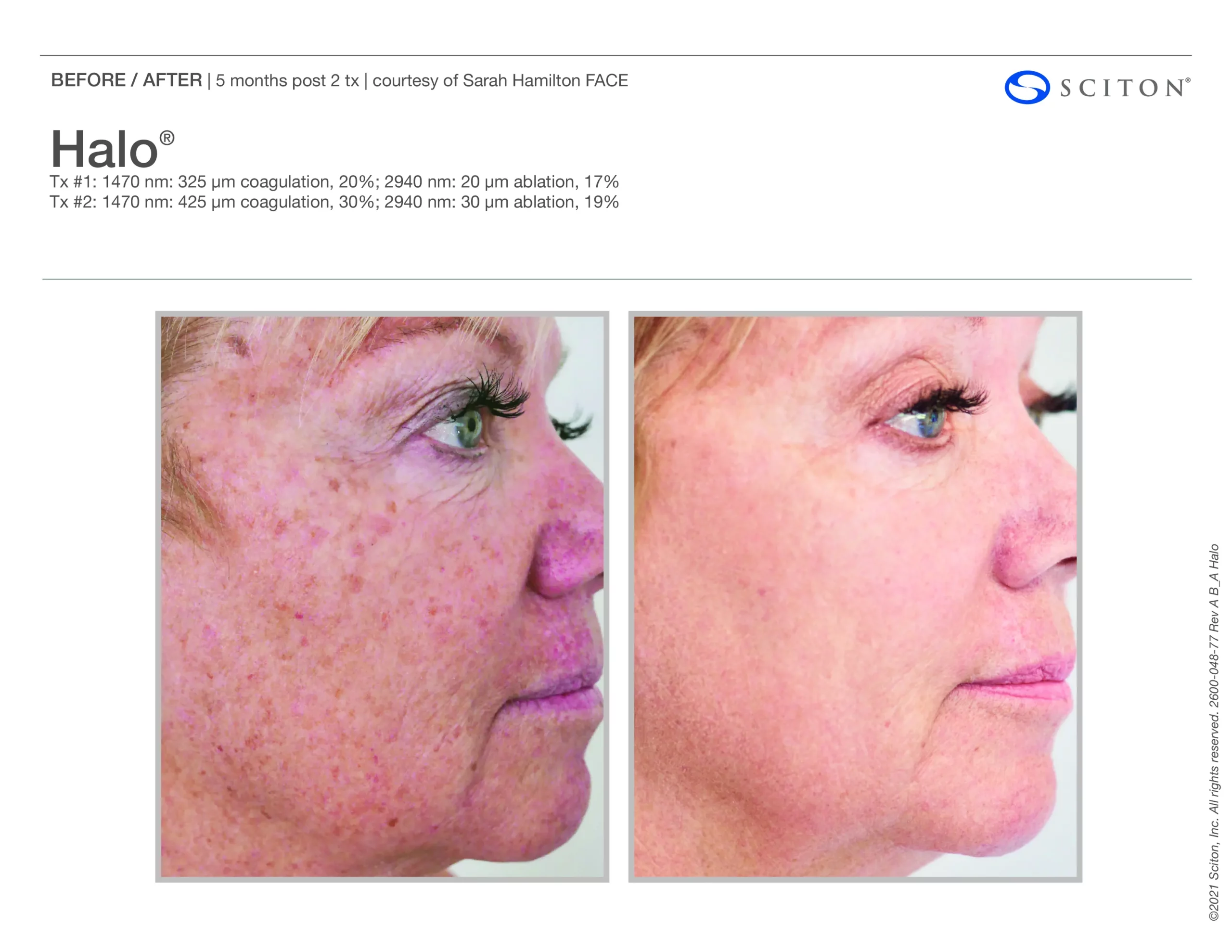 Sciton Halo Resurfacing e(binder) by Salt Aesthetics bar in Wilmington