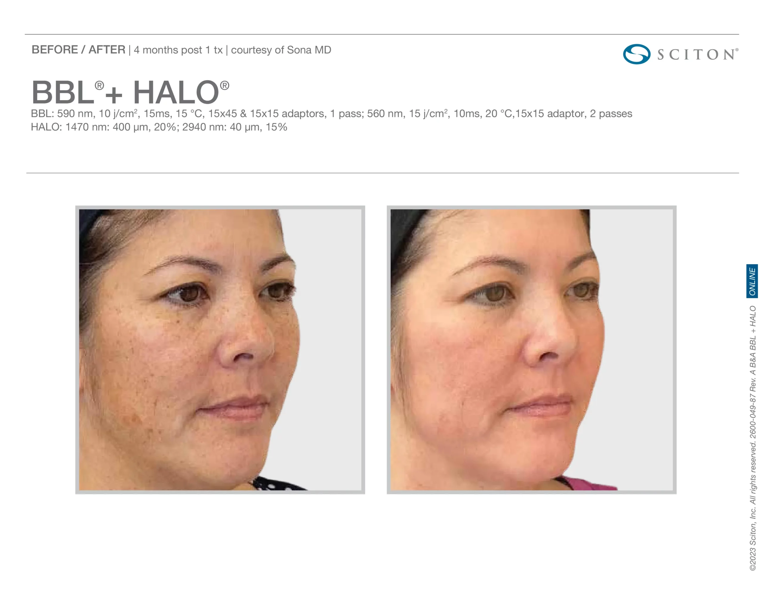 Sciton Halo Resurfacing f by Salt Aesthetics bar in Wilmington