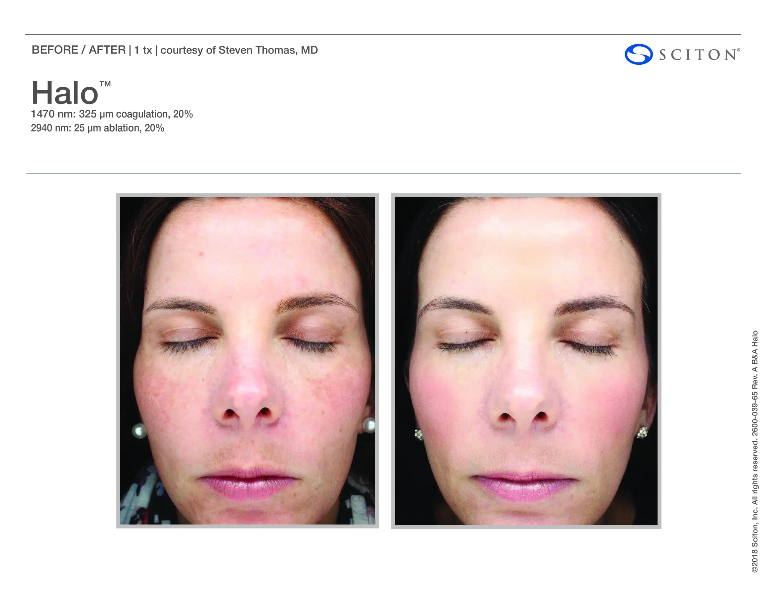 Sciton Halo Resurfacing(binder) by Salt Aesthetics bar in Wilmington