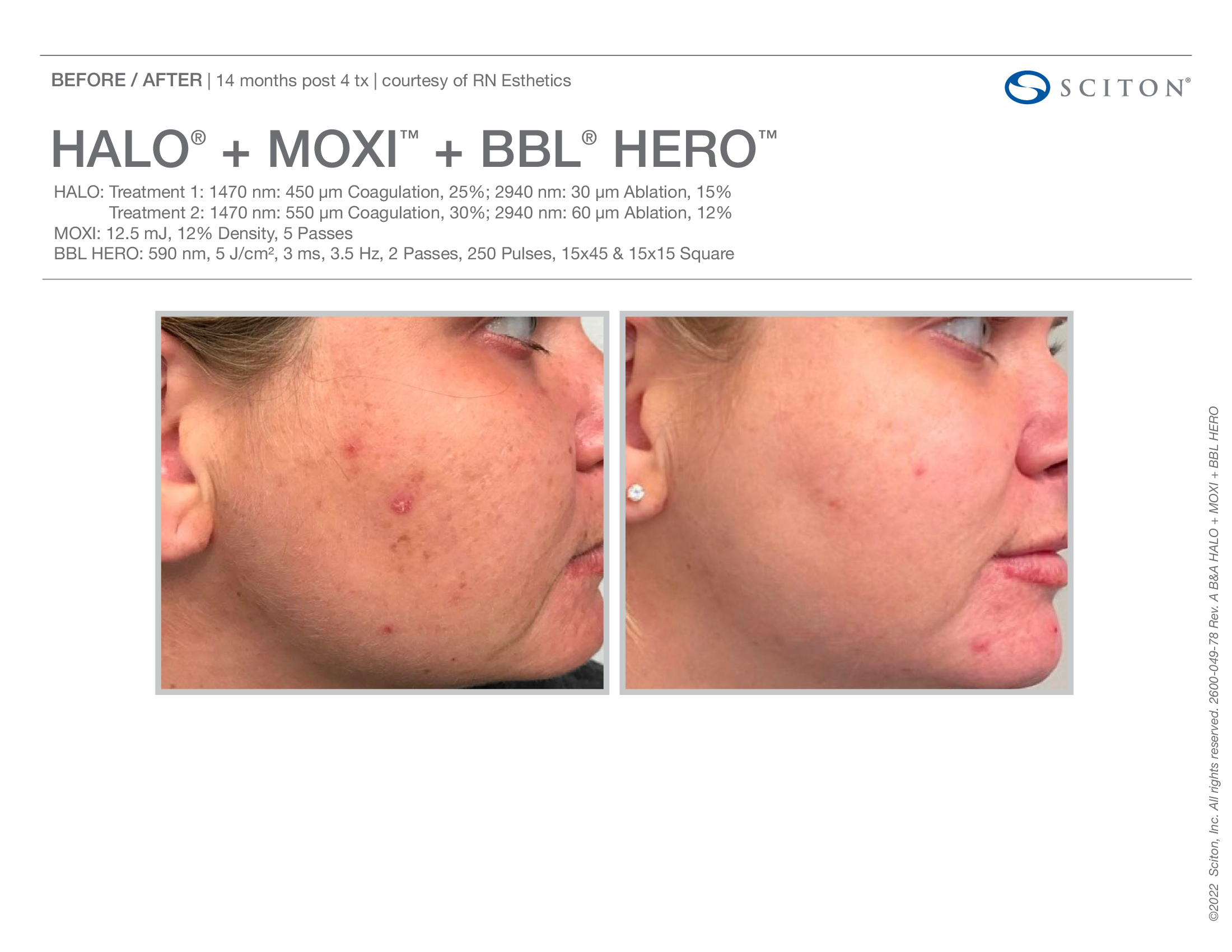 Sciton Moxi BBL F by Salt Aesthetics bar in Wilmington