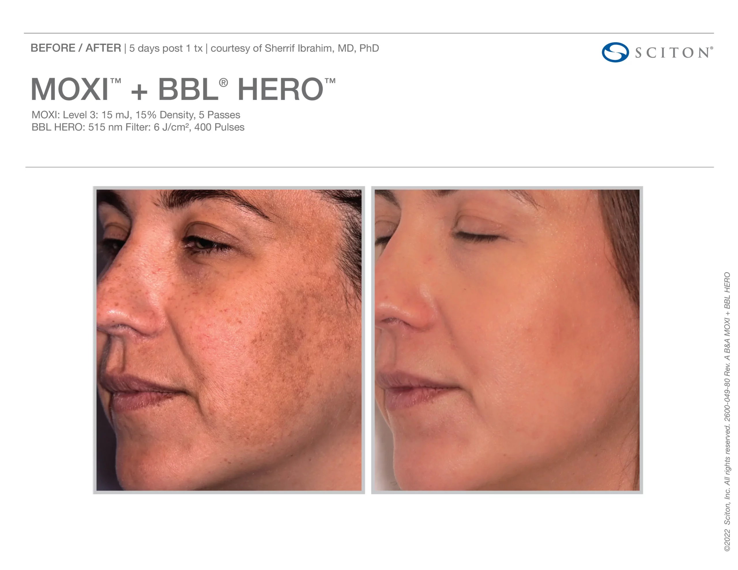 Sciton Moxi BBL G by Salt Aesthetics bar in Wilmington