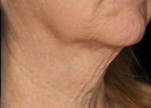 genius rf microneedling after results in Hampstead NC