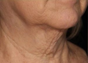 genius rf microneedling before results in Hampstead NC