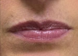 lip filler before in Wilmington NC