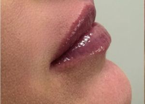 lip filler after results in Wilmington NC