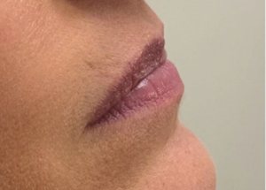 lip filler before results in Wilmington NC