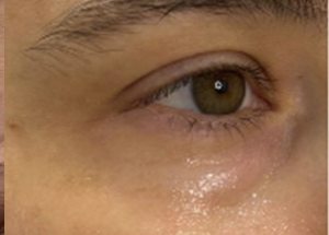 prf results before in Wilmington NC