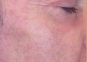 bbl and halo results after in Wilmington NC