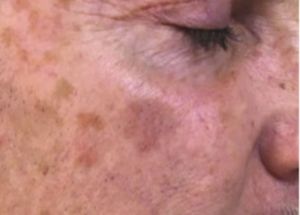 bbl and halo results before in Wilmington NC