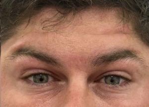 wrinkles after dysport and botox treatment in wilmington nc