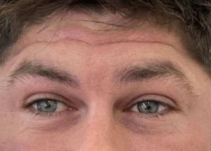 wrinkles before dysport and botox treatment in wilmington nc