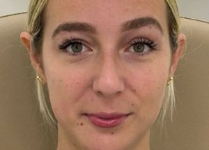 Dermal Fillers after results in wilmington nc