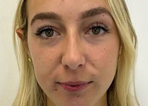 Dermal fillers before results in Wilmington patient