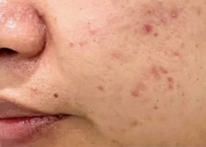 facials before results in Wilmington NC