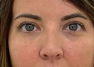 Dermal fillers after results in Hampstead patient