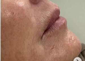 Dermal fillers after results
