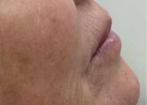 Dermal fillers before results