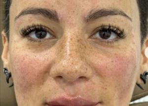 full face rejuvenation after results in Hampstead NC