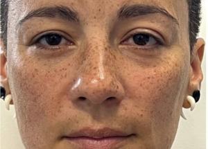 full face rejuvenation before results in Hampstead NC