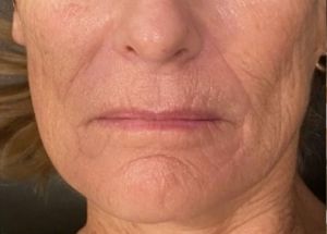 full facial balancing after results in Wilmington NC