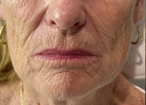 full facial balancing before results in Wilmington NC